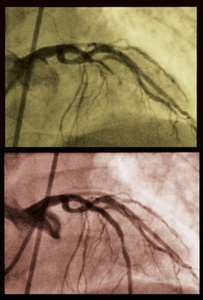 angiogram