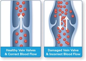 Varicose_vein_valves_thumb